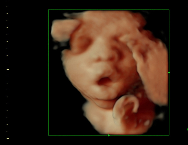 3D ultrasound image at 30 weeks